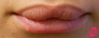 asportazione-silicone-labbra (1)